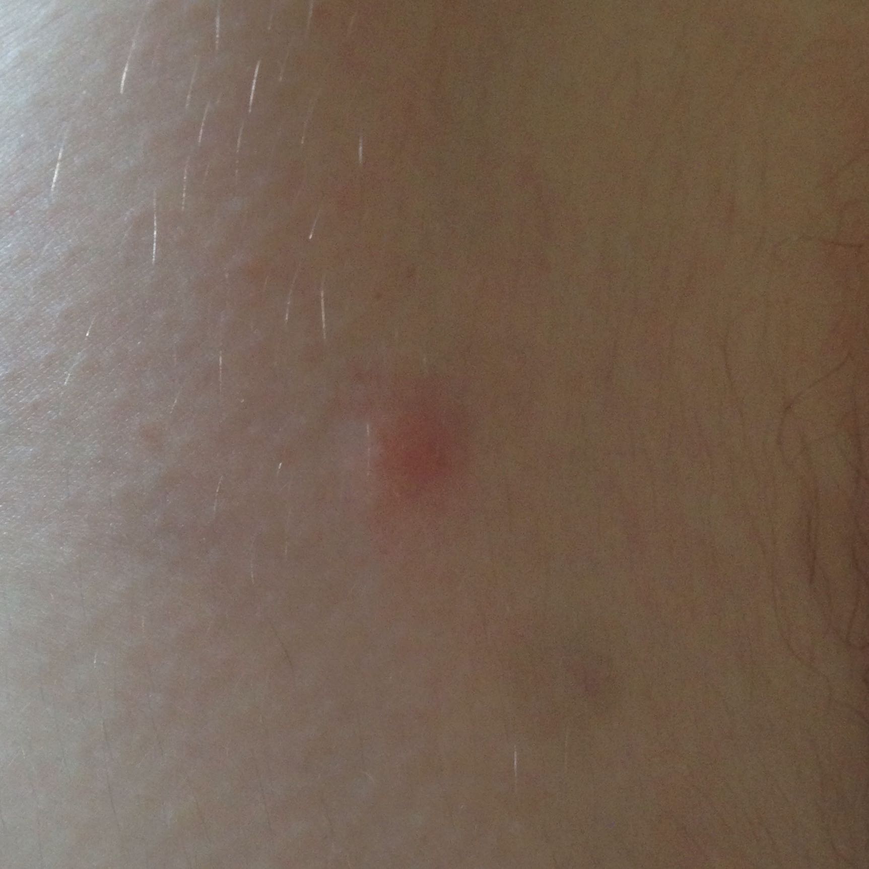 Leichte Wölbung der Haut nach Zeckenbiss (Gesundheit, Arzt, Zecken)